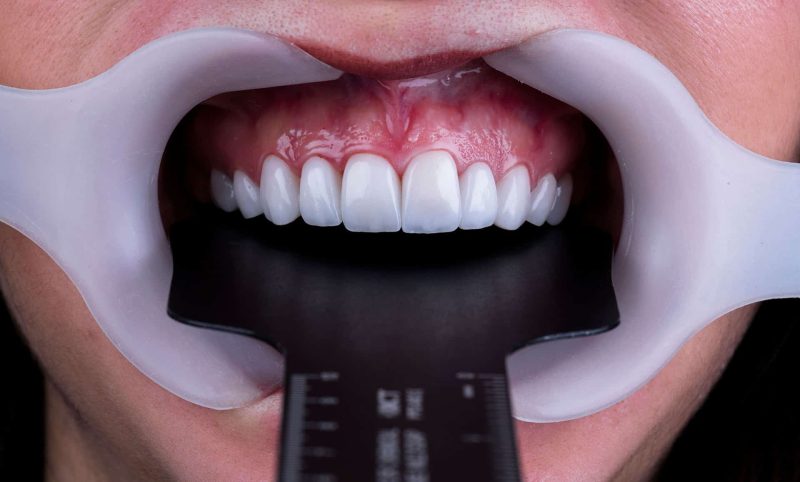 عکاسی دندانپزشکی